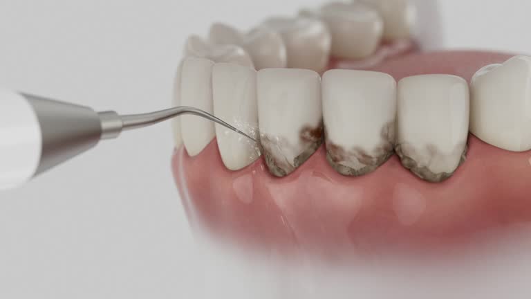 Trusted Wisdom Tooth Removal service in Clovis, NM - Dentist Open Now